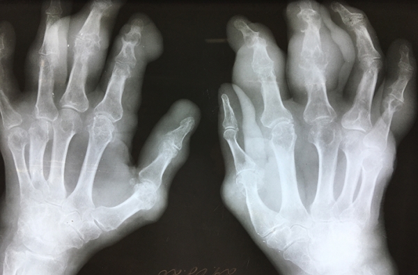 В капкане подагры			     
        В капкане подагры