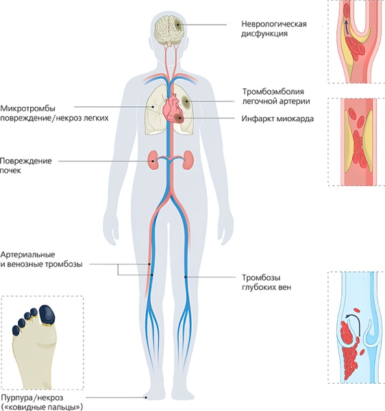 Исследование COVID-19-ассоциированной коагулопатии: что известно и что предстоит узнать?			     
        Исследование COVID-19-ассоциированной коагулопатии: что известно и что предстоит узнать?