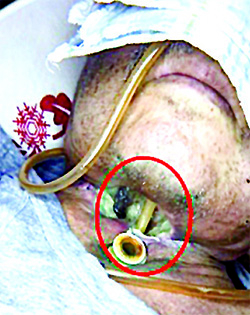 Онкологические заболевания гортани. Еще раз о важности регулярного наблюдения у профильных специалистов			     
        Онкологические заболевания гортани. Еще раз о важности регулярного наблюдения у профильных специалистов