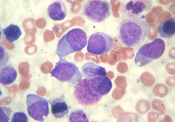 Острый миелоидный лейкоз у детей			     
        Острый миелоидный лейкоз у детей