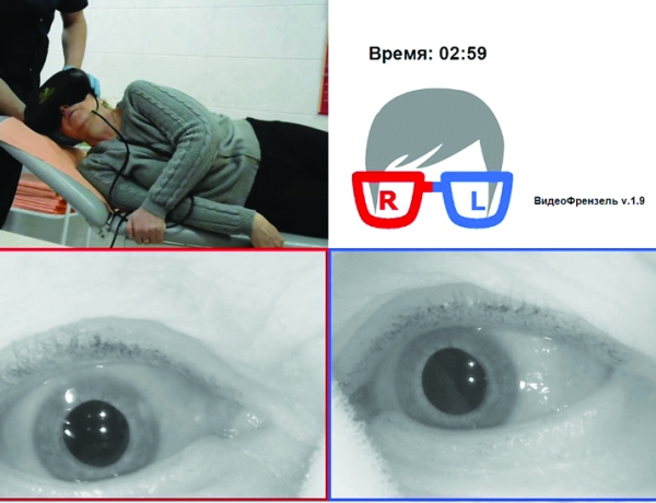 Доброкачественное позиционное пароксизмальное головокружение			
        
         
        Доброкачественное позиционное пароксизмальное головокружение