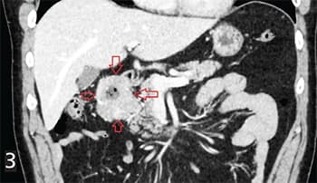 Гастроинтестинальные стромальные опухоли: взгляд рентгенолога			     
        Гастроинтестинальные стромальные опухоли: взгляд рентгенолога
