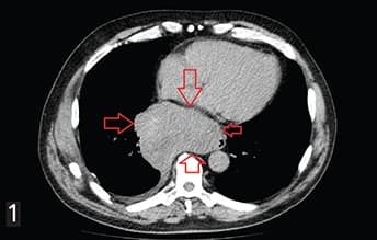Гастроинтестинальные стромальные опухоли: взгляд рентгенолога			     
        Гастроинтестинальные стромальные опухоли: взгляд рентгенолога
