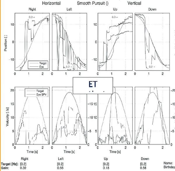 Периферический вестибулярный синдром			     
        Периферический вестибулярный синдром