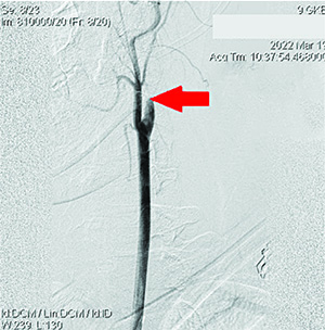 Острый ишемический инсульт у подростка: опыт комбинированного внутрисосудистого тромболизиса			     
        Острый ишемический инсульт у подростка: опыт комбинированного внутрисосудистого тромболизиса