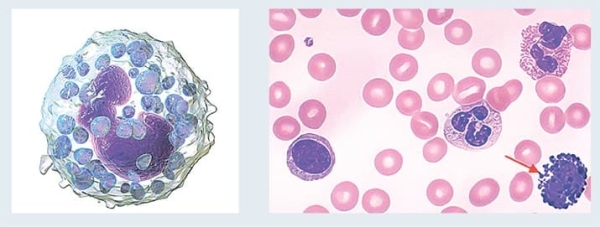Лейкоцитоз. Как правильно сдать анализ крови и расшифровать результат? 			     
        Лейкоцитоз. Как правильно сдать анализ крови и расшифровать результат?