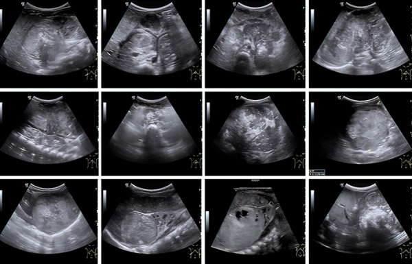 Нейробластома у детей: пути снижения запущенных случаев			     
        Нейробластома у детей: пути снижения запущенных случаев