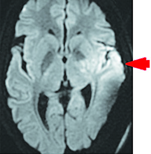 Острый ишемический инсульт у подростка: опыт комбинированного внутрисосудистого тромболизиса			     
        Острый ишемический инсульт у подростка: опыт комбинированного внутрисосудистого тромболизиса