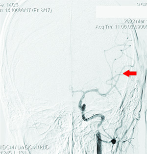 Острый ишемический инсульт у подростка: опыт комбинированного внутрисосудистого тромболизиса			     
        Острый ишемический инсульт у подростка: опыт комбинированного внутрисосудистого тромболизиса