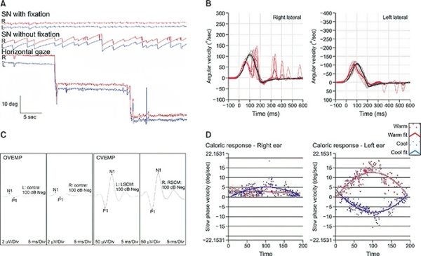 Периферический вестибулярный синдром			     
        Периферический вестибулярный синдром