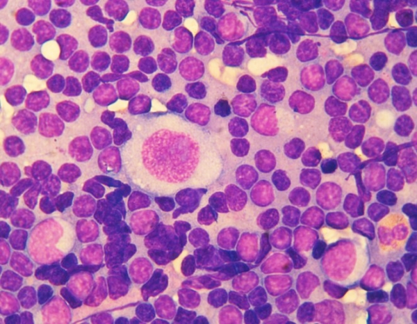 Лимфома Ходжкина у детей и подростков			     
        Лимфома Ходжкина у детей и подростков