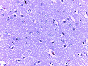 Патоморфологические изменения головного мозга при COVID-19			     
        Патоморфологические изменения головного мозга при COVID-19