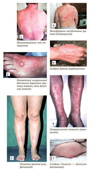 Важные вопросы лекарственной гиперчувствительности			     
        Важные вопросы лекарственной гиперчувствительности