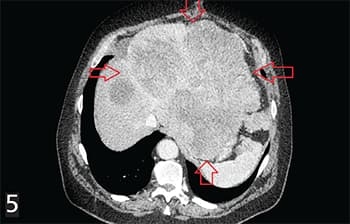 Гастроинтестинальные стромальные опухоли: взгляд рентгенолога			     
        Гастроинтестинальные стромальные опухоли: взгляд рентгенолога