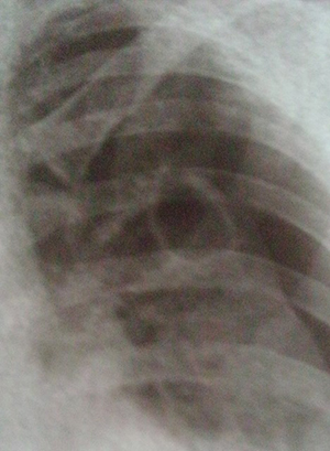 О терапии деструктивных форм туберкулеза легких 			     
        О терапии деструктивных форм туберкулеза легких