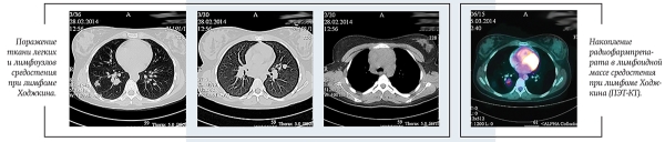 Лимфома Ходжкина у детей и подростков			     
        Лимфома Ходжкина у детей и подростков