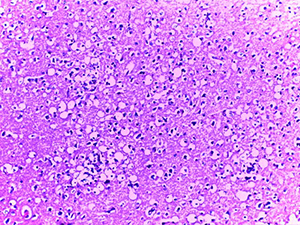 Патоморфологические изменения головного мозга при COVID-19			     
        Патоморфологические изменения головного мозга при COVID-19