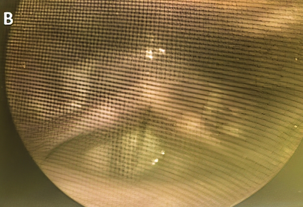 Нарушения голоса у пациентов с СOVID-19			     
        Нарушения голоса у пациентов с СOVID-19