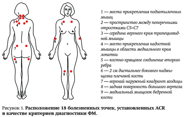 Современные аспекты диагностики и лечения фибромиалгии			     
        Современные аспекты диагностики и лечения фибромиалгии