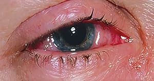 Возвращение туляремии…Что следующее?			     
        Возвращение туляремии…Что следующее?