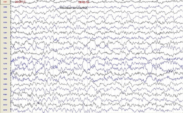 Пароксизмальные состояния у детей неэпилептического характера			     
        Пароксизмальные состояния у детей неэпилептического характера