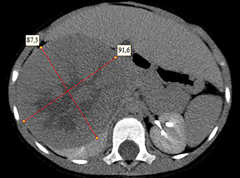 Нефробластомы у детей: что необходимо знать			     
        Нефробластомы у детей: что необходимо знать