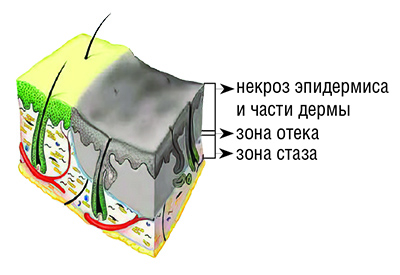 Ожоги: принципы диагностики и выбор тактики лечения. Часть 1			     
        Ожоги: принципы диагностики и выбор тактики лечения. Часть 1