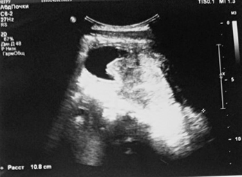 Нейрогенный мочевой пузырь			     
        Нейрогенный мочевой пузырь