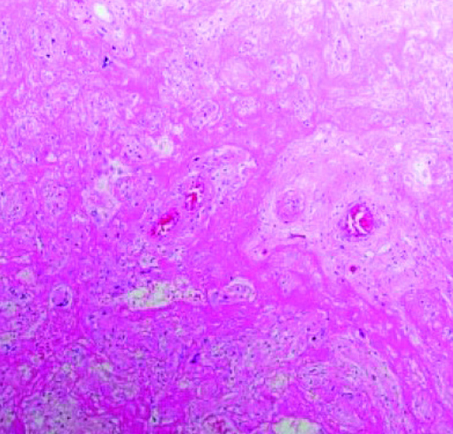 Патология плаценты при COVID-19			     
        Патология плаценты при COVID-19