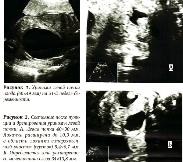 Обструкция верхних отделов мочевыводящей системы у плода. Клинический случай			     
        Обструкция верхних отделов мочевыводящей системы у плода. Клинический случай