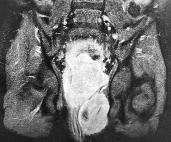 Нейрогенный мочевой пузырь			     
        Нейрогенный мочевой пузырь