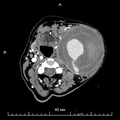 Специалистами отделения сосудистой хирургии Гродненской университетской клиники проведена уникальная операция по удалению аневризмы сонной артерии			     
        Специалистами отделения сосудистой хирургии Гродненской университетской клиники проведена уникальная операция по удалению аневризмы сонной артерии