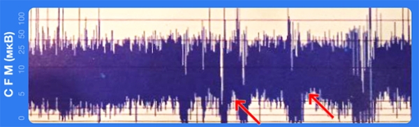 Терапевтическая гипотермия в неонатологии			     
        Терапевтическая гипотермия в неонатологии