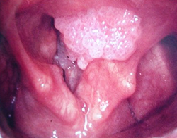Предраковые заболевания гортани +аудио			
        
         
        Предраковые заболевания гортани +аудио