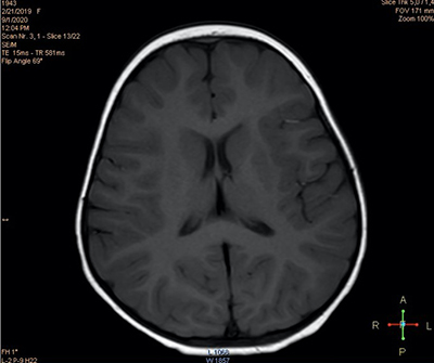 Пароксизмальные состояния у детей неэпилептического характера			     
        Пароксизмальные состояния у детей неэпилептического характера