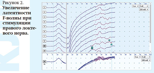 Хроническая воспалительная  демиелинизирующая полиневропатия с острым началом у беременной			     
        Хроническая воспалительная  демиелинизирующая полиневропатия с острым началом у беременной