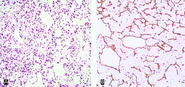 Опухоль в сердце: сложности диагностики и хирургии			     
        Опухоль в сердце: сложности диагностики и хирургии