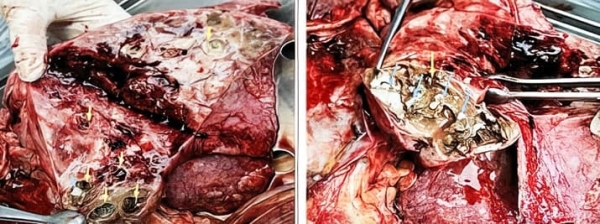 COVID-ассоциированный инвазивный легочный аспергиллез: проблемы диагностики и лечения			     
        COVID-ассоциированный инвазивный легочный аспергиллез: проблемы диагностики и лечения