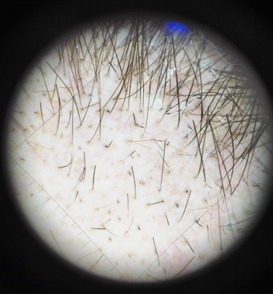 COVID-19 и выпадение волос			     
        COVID-19 и выпадение волос