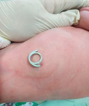 Обструкция верхних отделов мочевыводящей системы у плода. Клинический случай			     
        Обструкция верхних отделов мочевыводящей системы у плода. Клинический случай