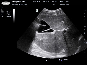 Аномалии развития билиарного тракта у детей и их клинико-патогенетическое значение			     
        Аномалии развития билиарного тракта у детей и их клинико-патогенетическое значение