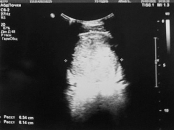 Нейрогенный мочевой пузырь			     
        Нейрогенный мочевой пузырь