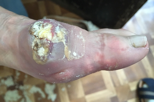 В капкане подагры			     
        В капкане подагры