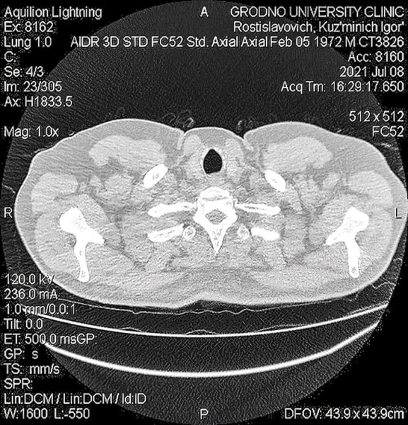 COVID-ассоциированный инвазивный легочный аспергиллез: проблемы диагностики и лечения			     
        COVID-ассоциированный инвазивный легочный аспергиллез: проблемы диагностики и лечения