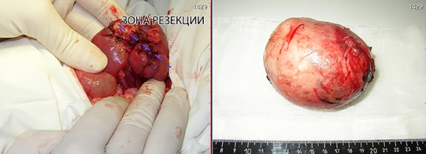 Нефробластомы у детей: что необходимо знать			     
        Нефробластомы у детей: что необходимо знать