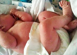 Ранняя диагностика тяжелых комбинированных иммунодефицитов			     
        Ранняя диагностика тяжелых комбинированных иммунодефицитов