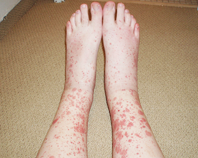 Дерматологические осложнения COVID-19 и тактика ведения пациентов с заболеваниями кожи			     
        Дерматологические осложнения COVID-19 и тактика ведения пациентов с заболеваниями кожи