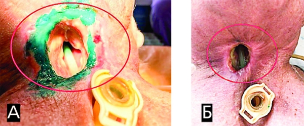 Онкологические заболевания гортани. Еще раз о важности регулярного наблюдения у профильных специалистов			     
        Онкологические заболевания гортани. Еще раз о важности регулярного наблюдения у профильных специалистов