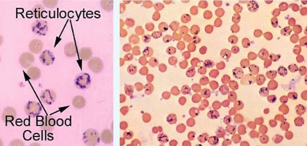 Гемолитические анемии у детей: клиника и алгоритм диагностики			     
        Гемолитические анемии у детей: клиника и алгоритм диагностики